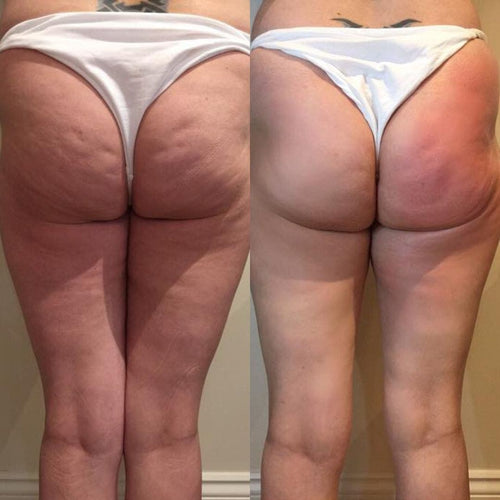 Ultrasonic Cavitation